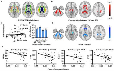 The white matter characteristic of the genu of corpus callosum coupled with pain intensity and negative emotion scores in patients with trigeminal neuralgia: a multivariate analysis